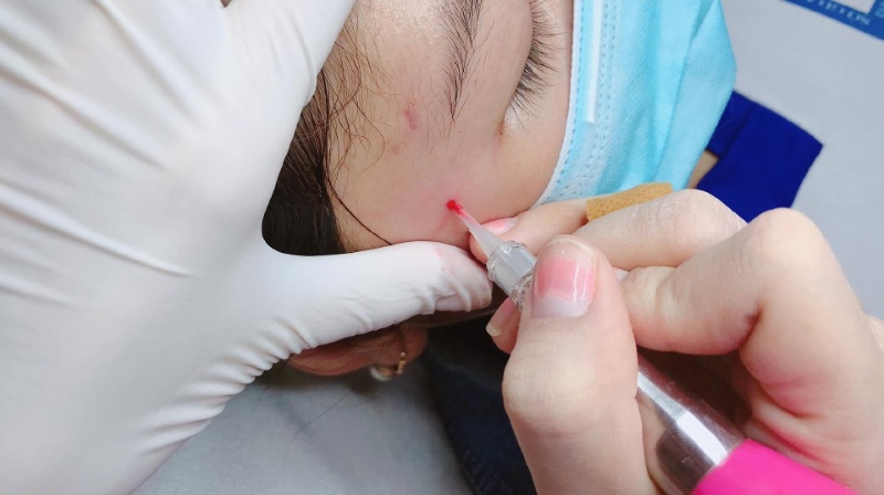 Xăm nốt ruồi son trên mặt có nên không