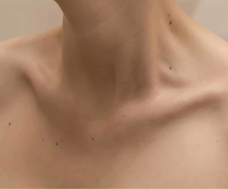 Xuất hiện nhiều nốt ruồi mới