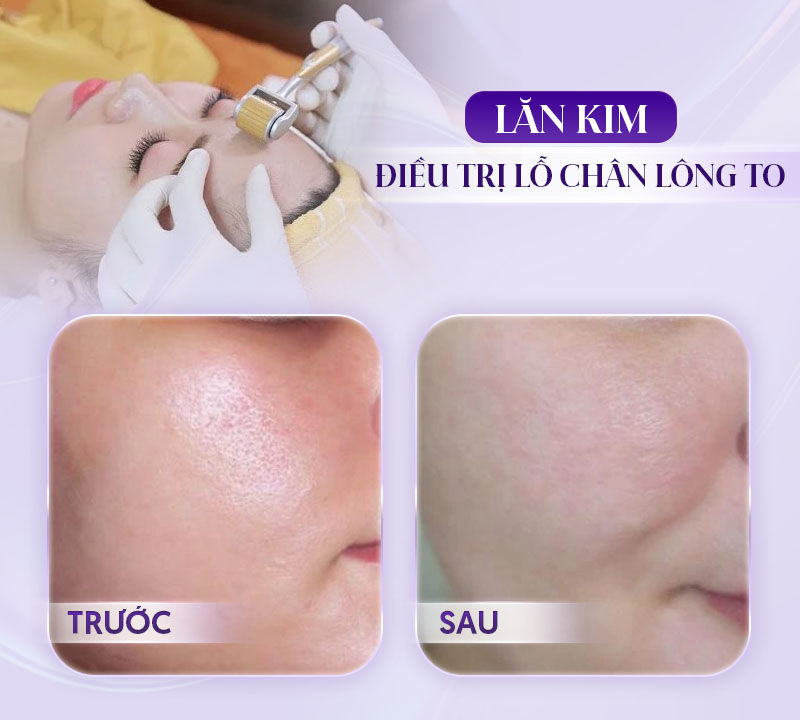 Cơ chế hoạt động của lăn kim