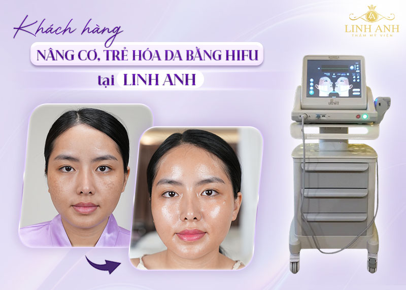 Công nghệ HIFU trong thẩm mỹ