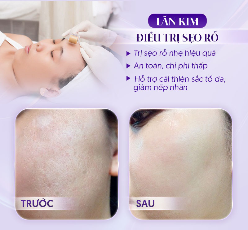 Lăn kim trị sẹo