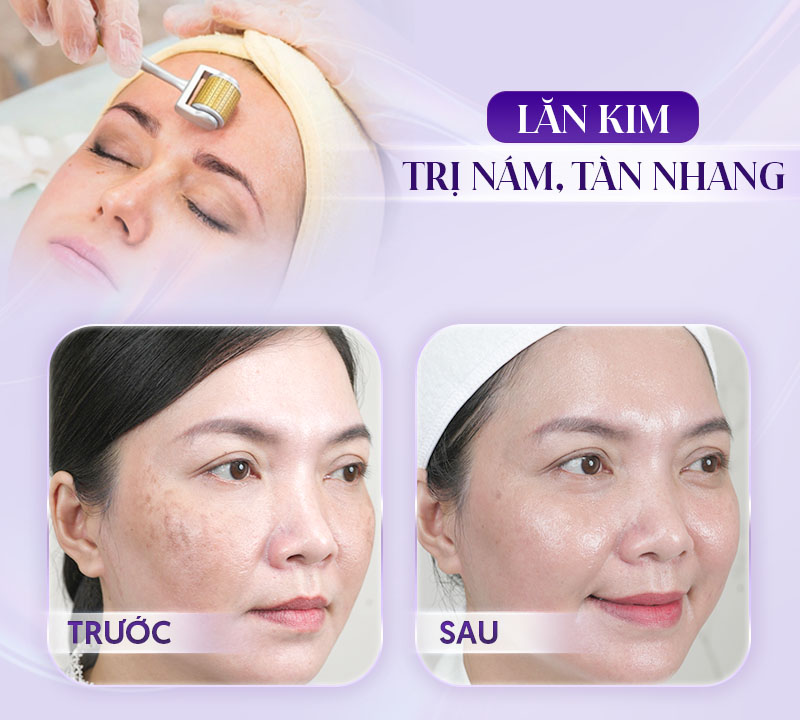 Lăn kim trong thẩm mỹ da