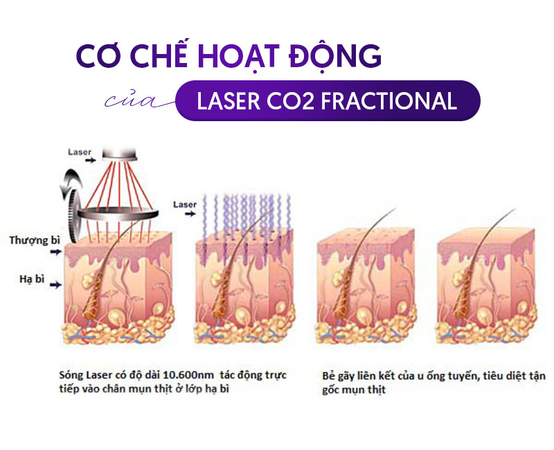 Laser Fractional CO2 là gì