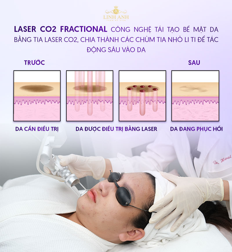 Laser Fractional CO2