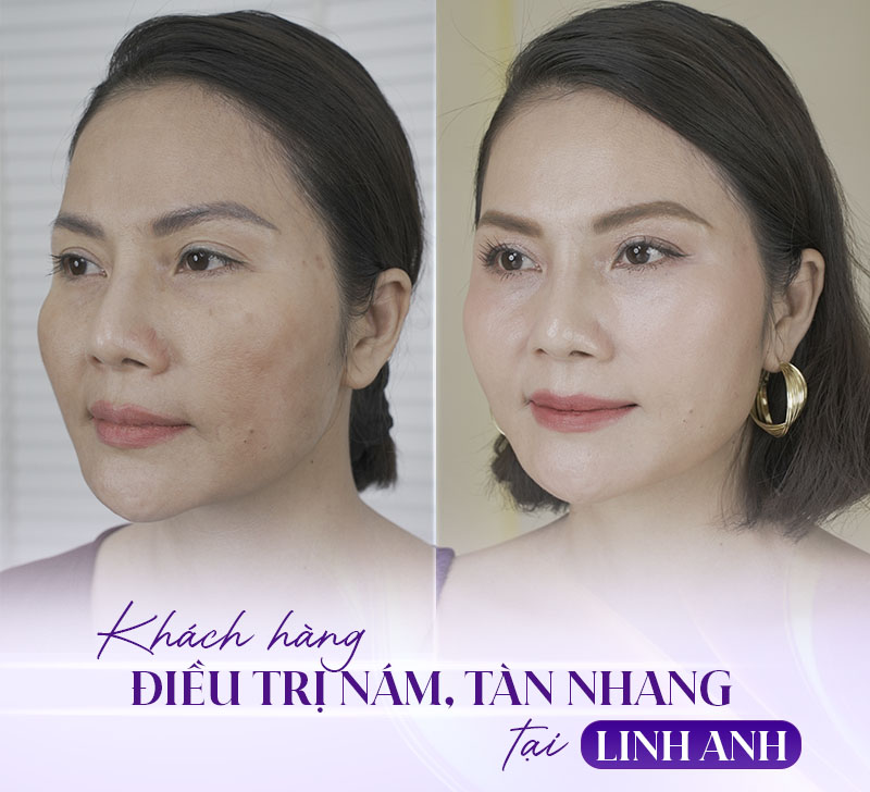 Quy trình lăn kim