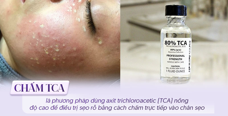 TCA là gì