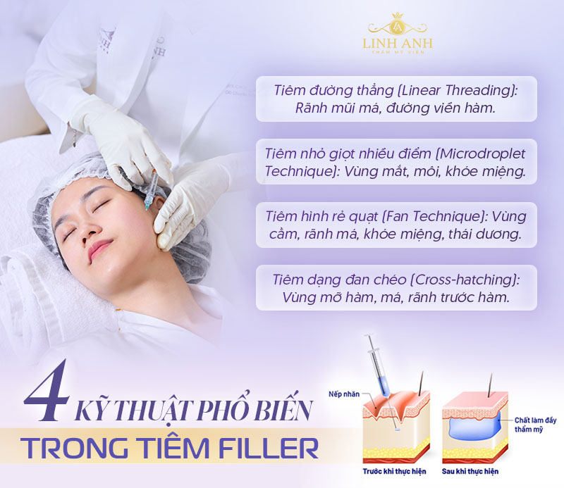 Các Kỹ thuật tiêm filler