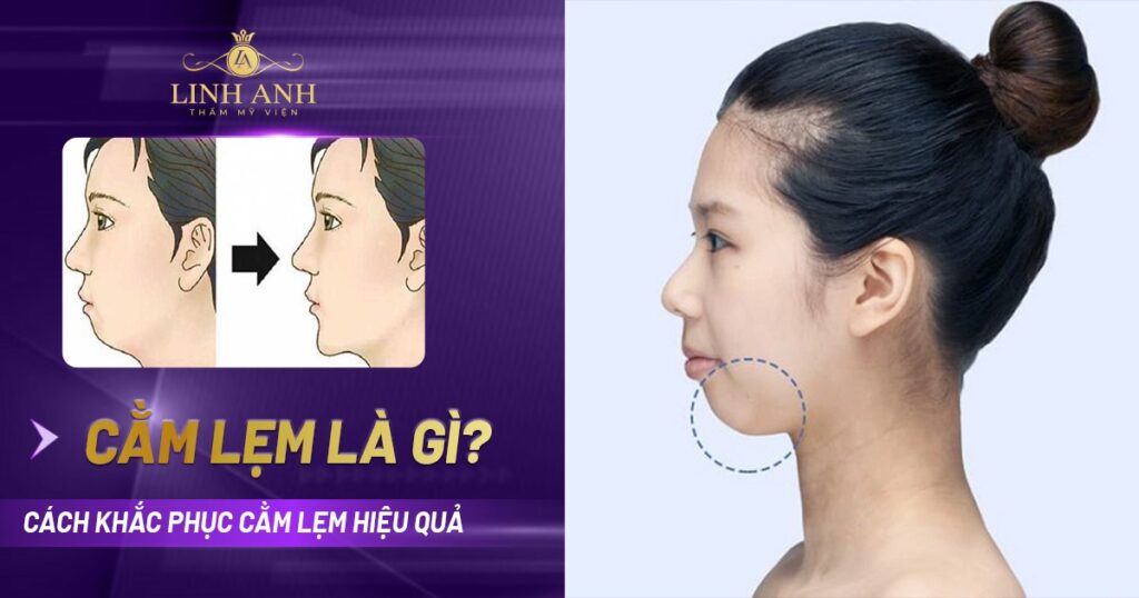 Cằm lẹm