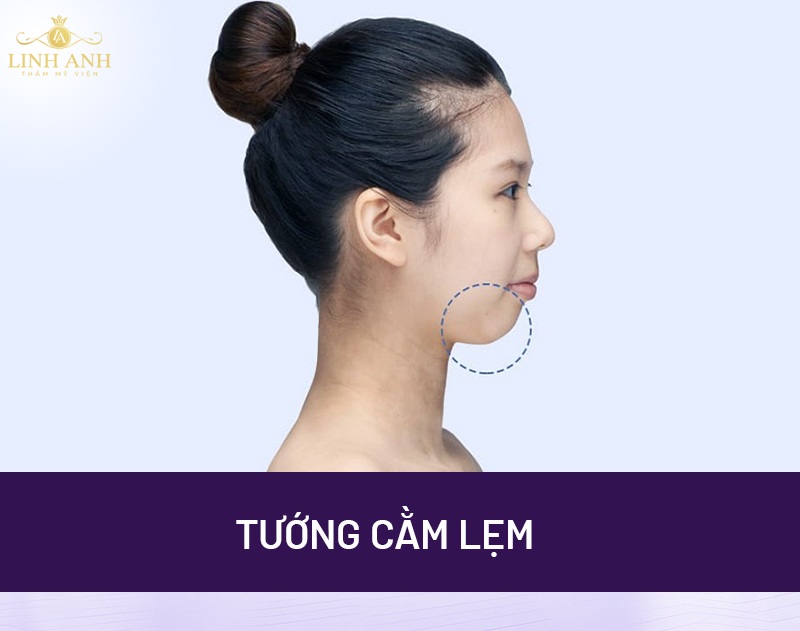 Cằm lẹm là gì