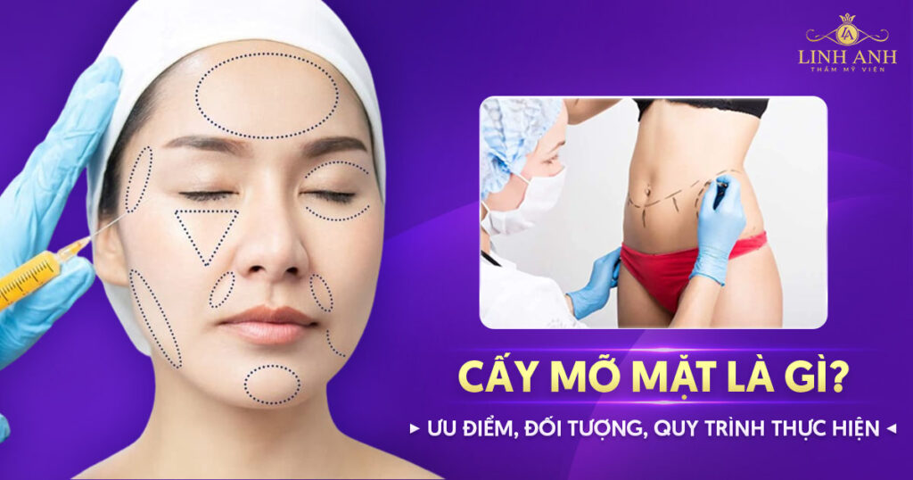 cấy mỡ mặt