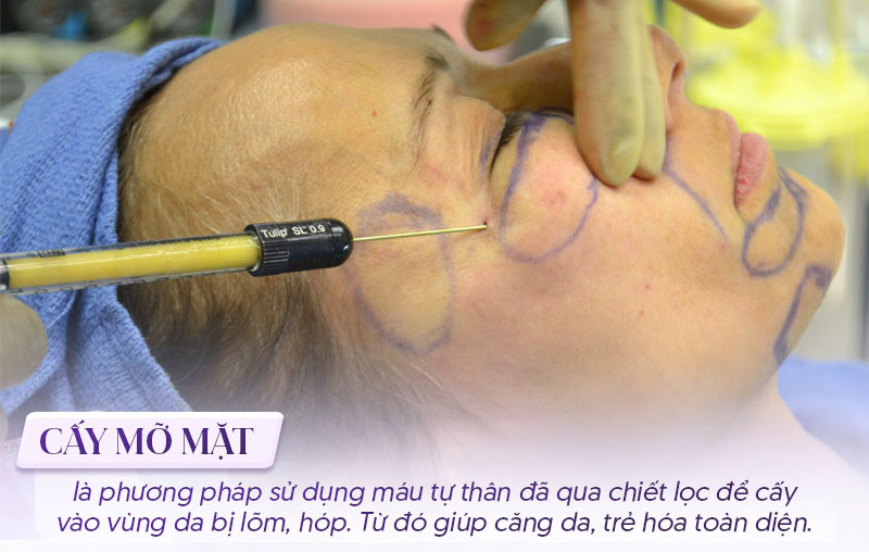 cấy mỡ mặt có an toàn không