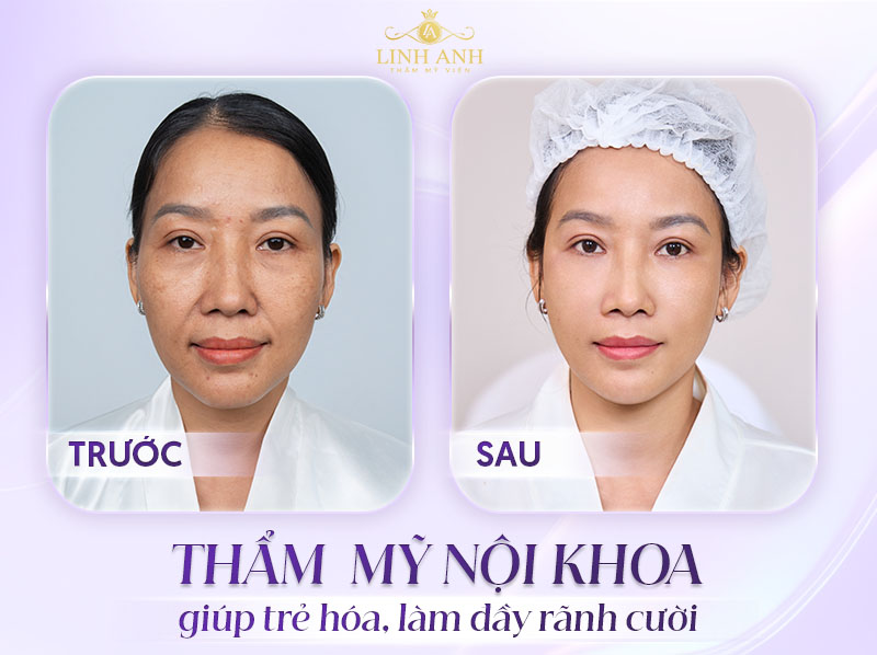 cấy mỡ mặt giúp trẻ hóa da