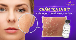 chấm TCA