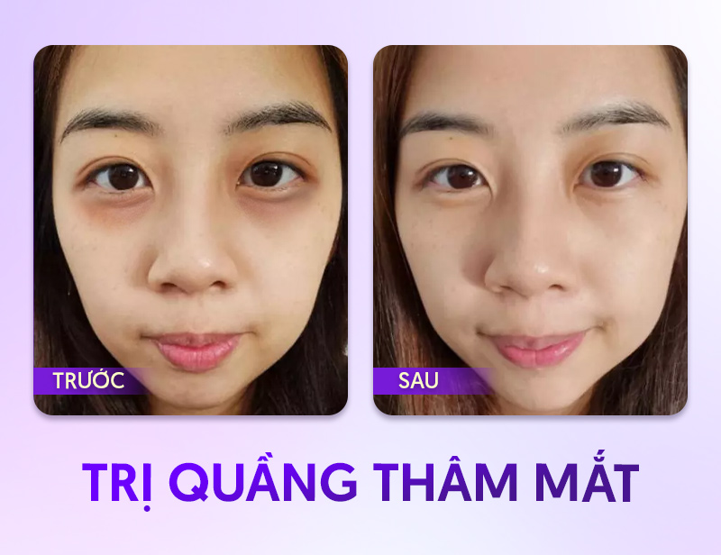 chi phí xóa thâm mắt vĩnh viễn