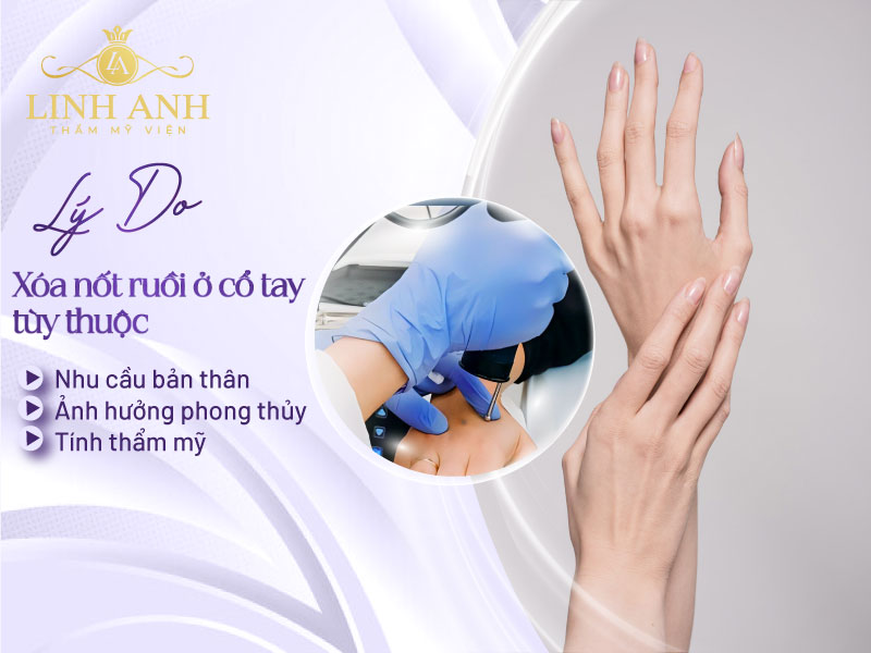 Có nên xóa Nốt ruồi ở cổ tay