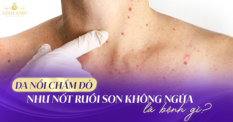 Da nổi chấm đỏ như nốt ruồi son không ngứa là bệnh gì?