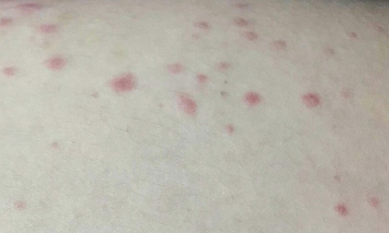 da nổi nhiều chấm đỏ như nốt ruồi son