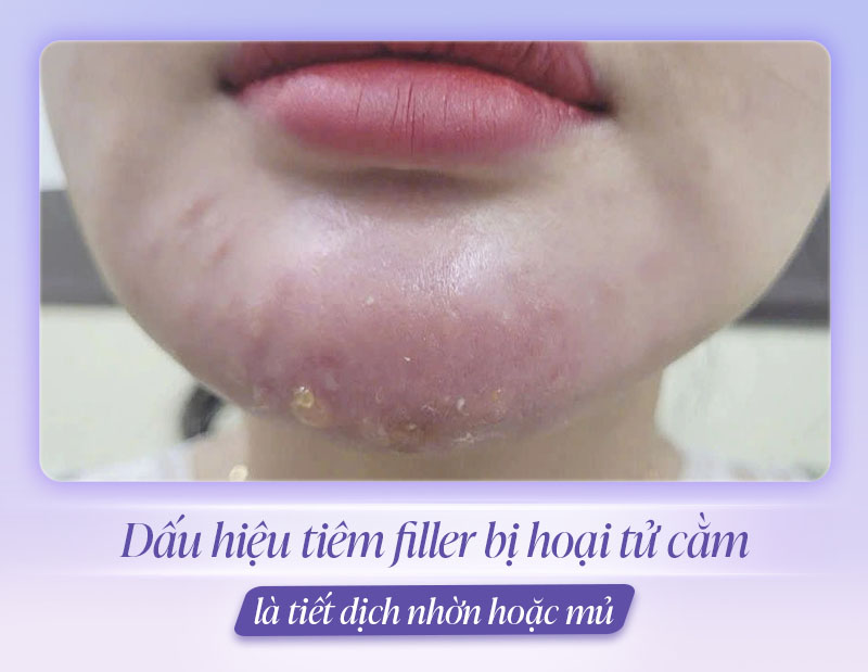 Dấu hiệu hoại tử cằm