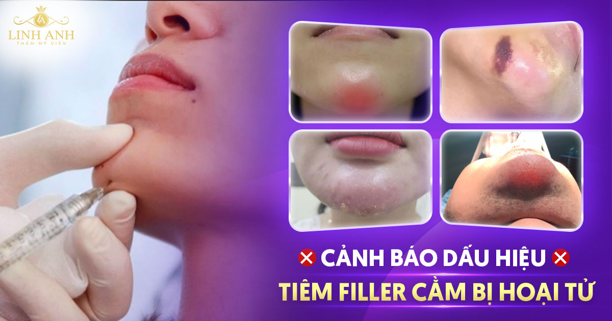 Hình ảnh dấu hiệu tiêm filler bị hoại tử cằm cần chú ý