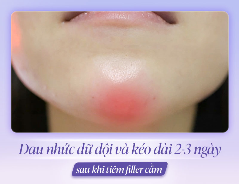 Dấu hiệu tiêm filler cằm bị hoại tử