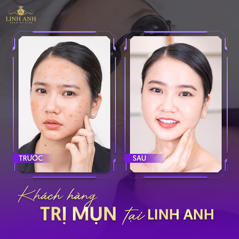 địa chỉ nặn mụn uy tín