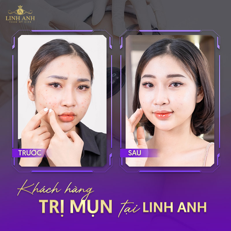 địa chỉ nặn mụn
