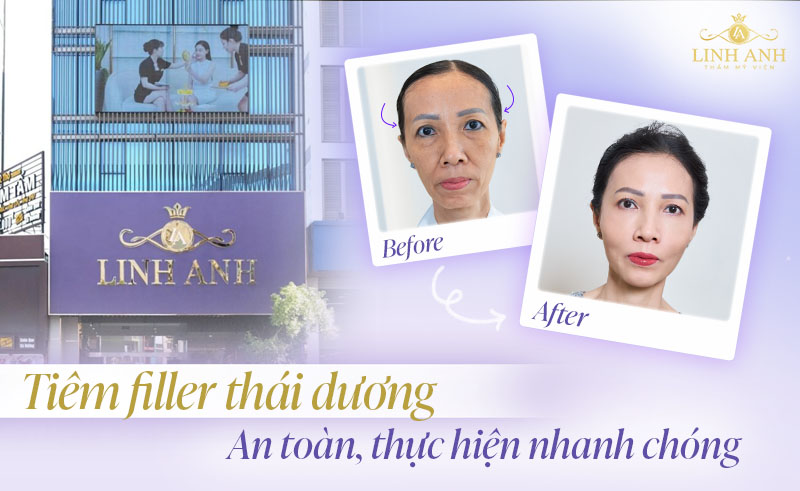 Địa chỉ tiêm filler thái dương