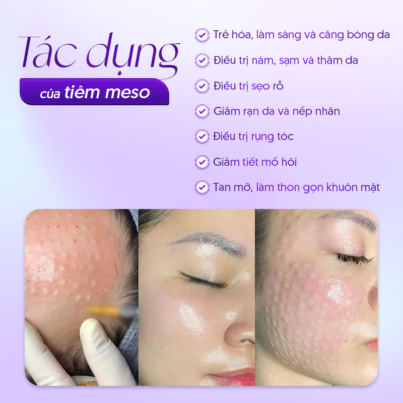 dịch vụ Tiêm Meso