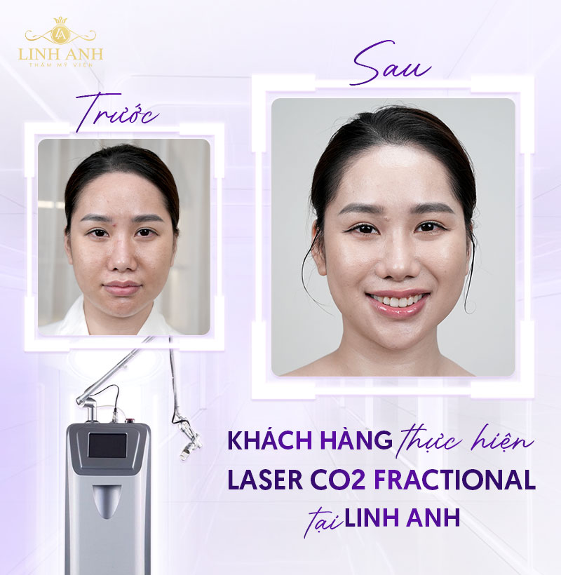 điều trị da bằng Laser CO2 Fractional