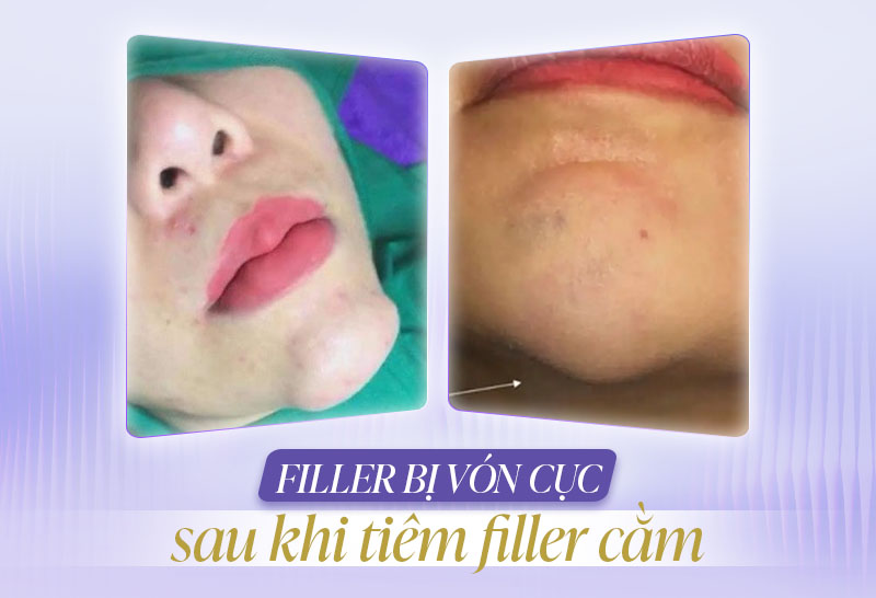 Filler bị vón cục sau khi tiêm filler cằm