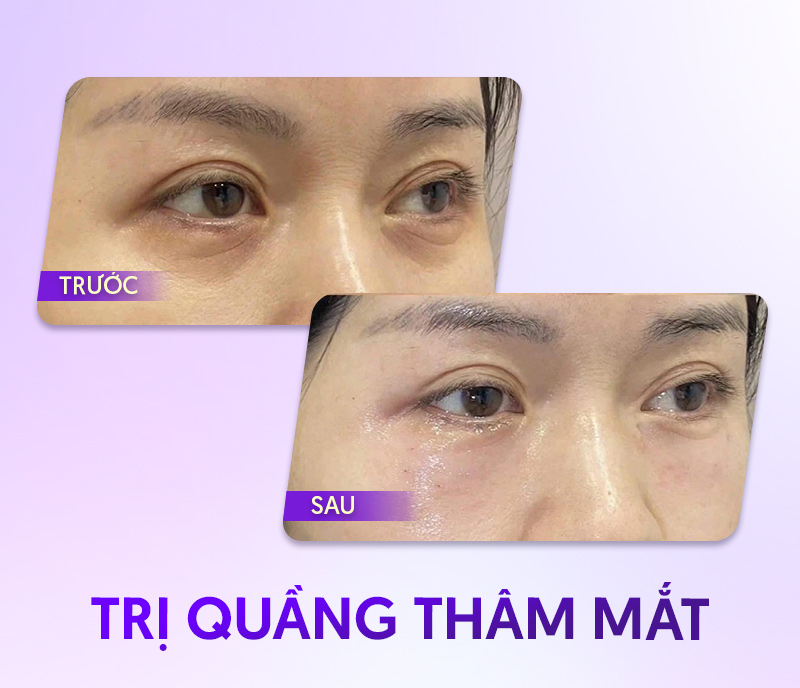 giá xóa quầng thâm mắt vĩnh viễn