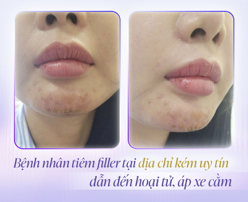 Hình ảnh hoại tử cằm