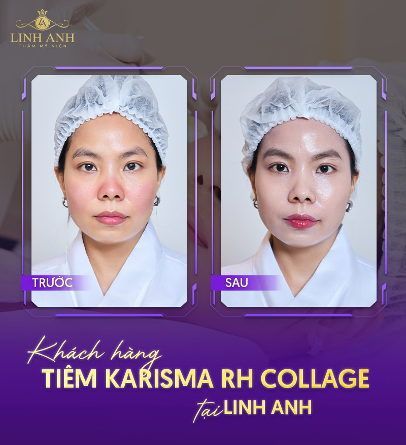 Khách hàng sau tiêm Karisma rh collagen