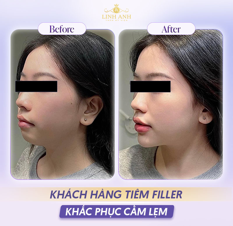 Hình ảnh sau tiêm filler cằm lẹm