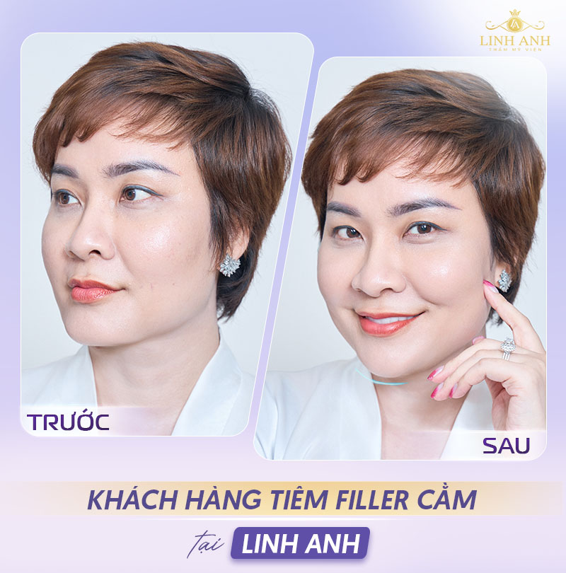Hình ảnh sau tiêm filler cằm tại Linh Anh