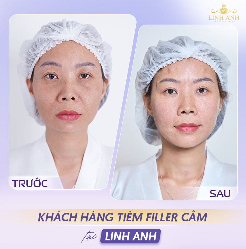 Hình ảnh sau khi Tiêm filler cằm