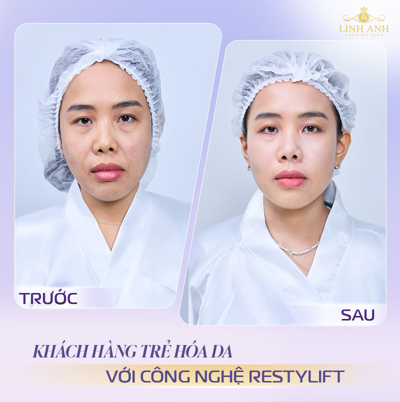 Hình ảnh sau tiêm filler rãnh cười