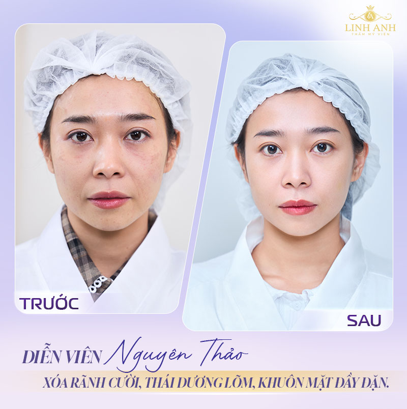 Hình ảnh trước và sau khi tiêm rãnh cười