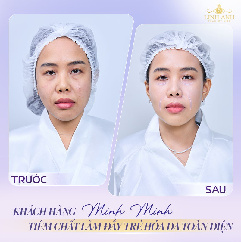 Khách hàng tiêm cải thiện rãnh cười