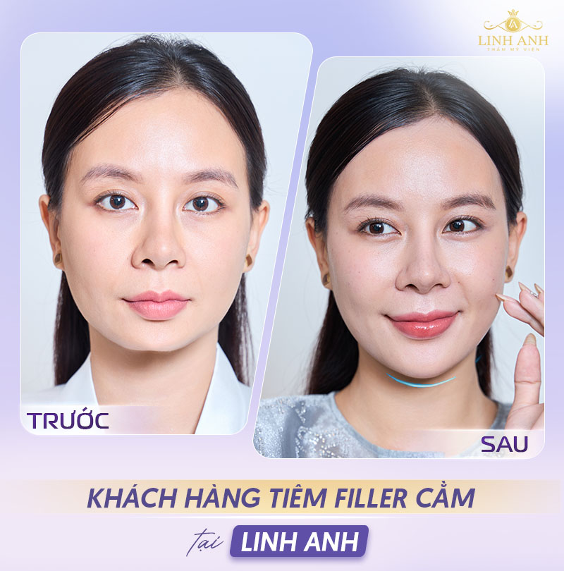 Khách hàng tiêm filler cằm tại Linh Anh