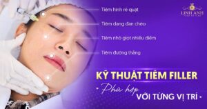 Kỹ thuật tiêm filler