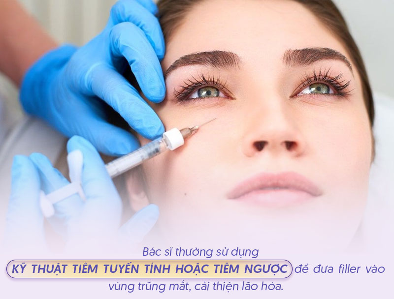 Kỹ thuật tiêm filler an toàn