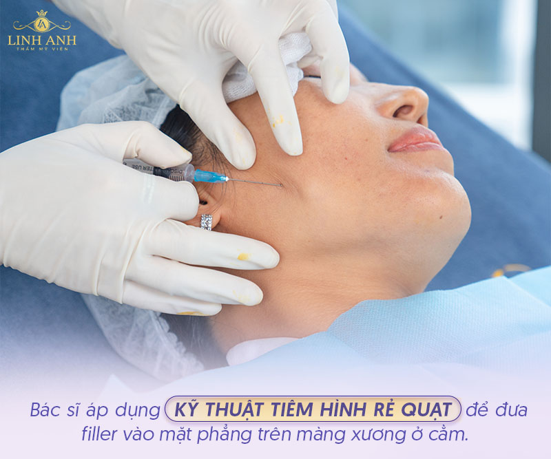 Kỹ thuật tiêm filler cằm