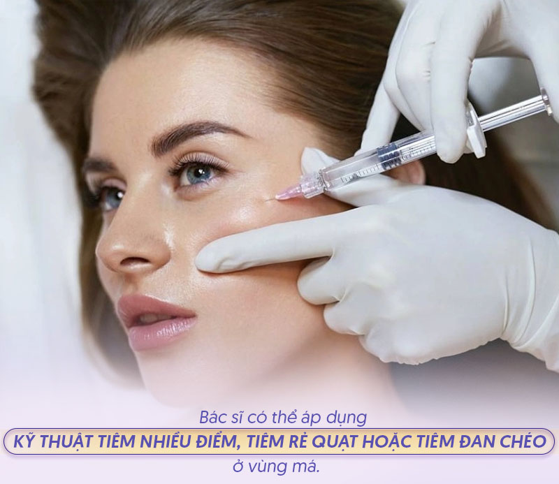 Kỹ thuật tiêm filler má
