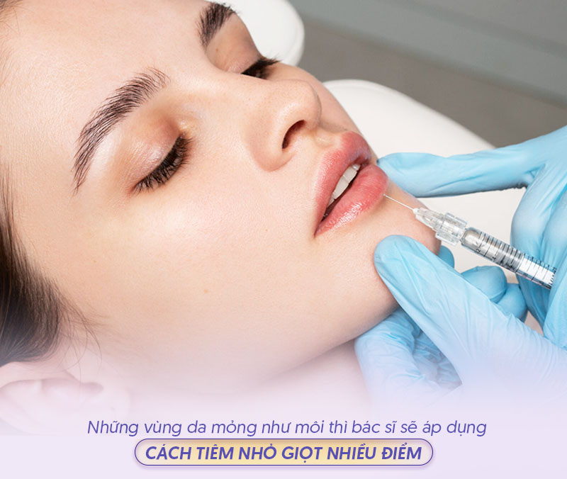 Kỹ thuật tiêm filler môi