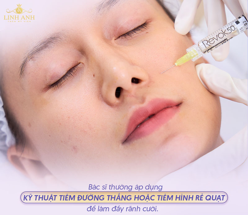 Kỹ thuật tiêm filler rãnh cười
