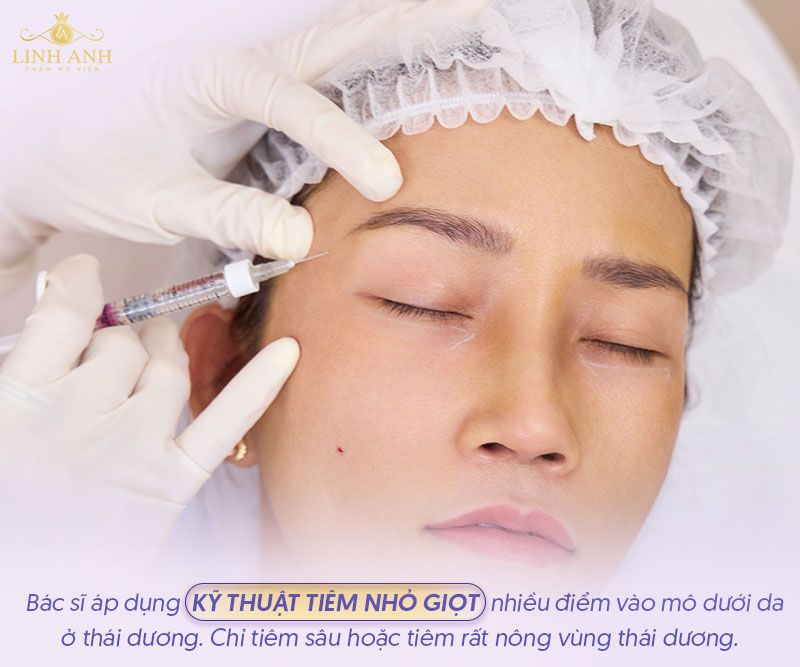 Kỹ thuật tiêm filler thái dương