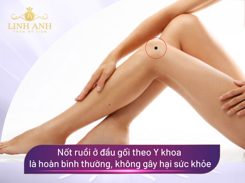 mụn ruồi ở đầu gối