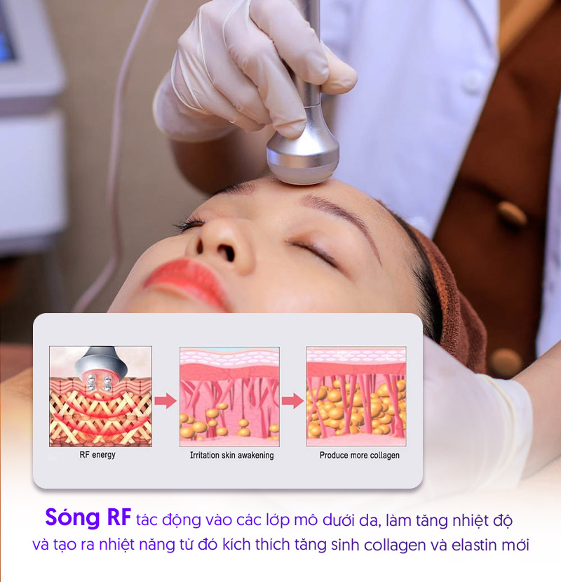 nâng cơ bằng sóng RF