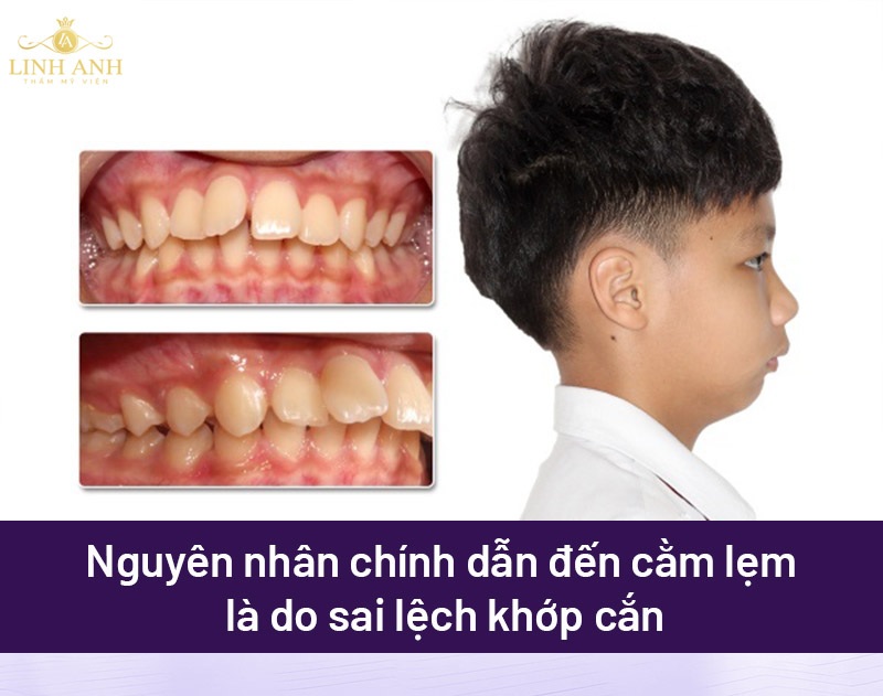 Nguyên nhân dẫn đến tình trạng cằm lẹm